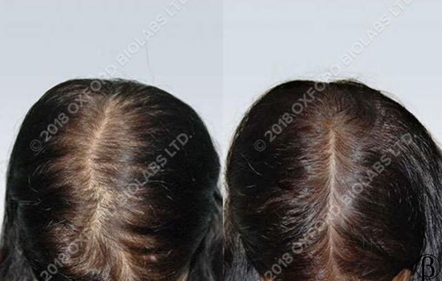 TRX2 Hair Growth Complex - Молекулярный комплекс против выпадения волос OXFORD BIOLABS, 1 банка * 90 капсул (1 місяць)