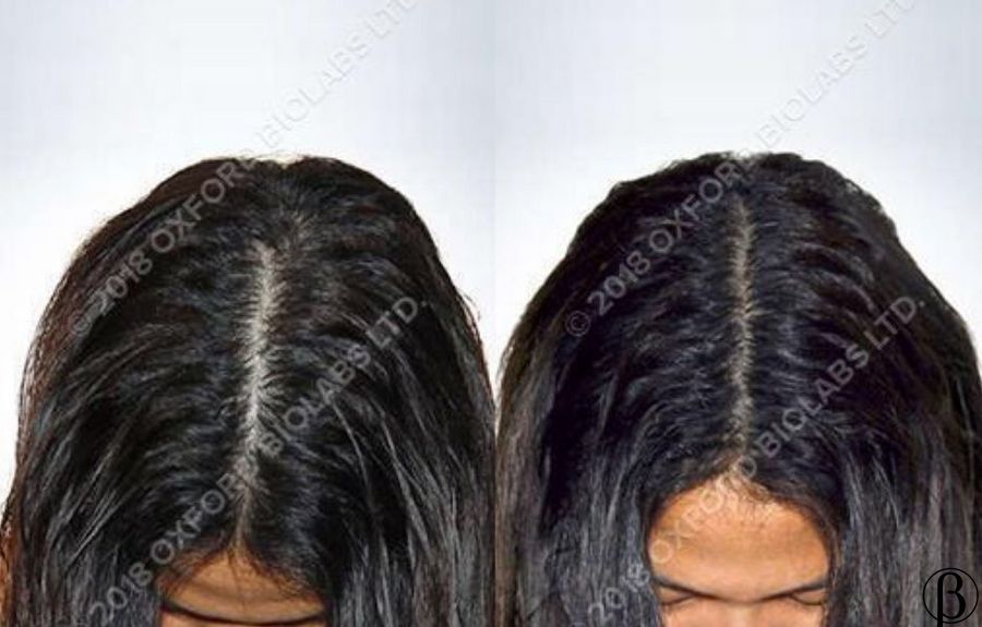 TRX2 Hair Growth Complex - Молекулярний комплекс проти випадіння волосся OXFORD BIOLABS, 1 банка * 90 капсул (1 місяць)