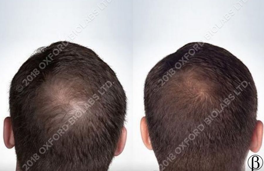 TRX2 Hair Growth Complex - Молекулярний комплекс проти випадіння волосся OXFORD BIOLABS, 1 банка * 90 капсул (1 місяць)